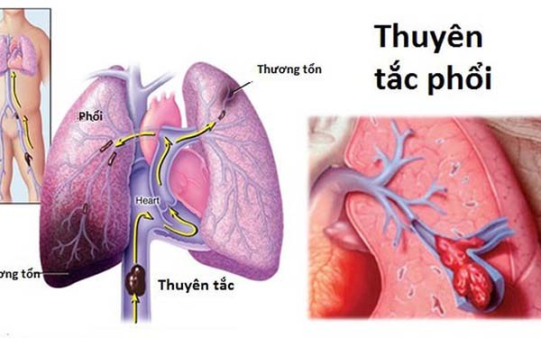 "Giải đáp" chi tiết về Đợt Cấp COPD và cách điều trị bệnh hiệu quả