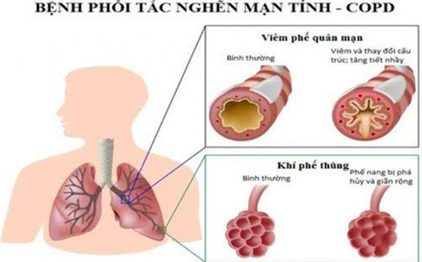 Tắc nghẽn phổi mãn tính sống được bao lâu? Chữa được không?