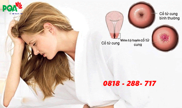 Các phương pháp chữa viêm lộ tuyến cổ tử cung. Cách nào hiệu quả?