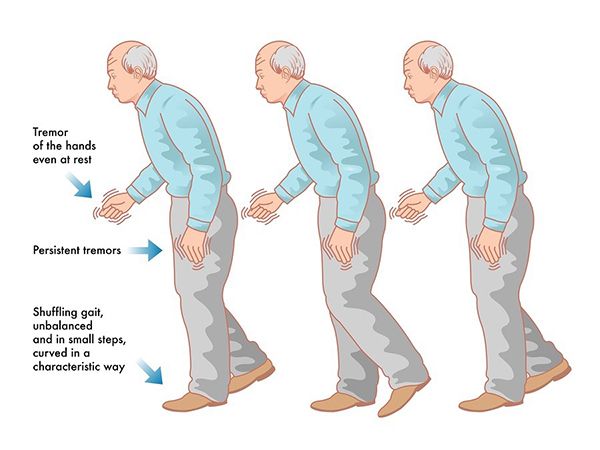 Bệnh parkinson giai đoạn cuối: Cách kiểm soát và cải thiện bệnh hiệu quả