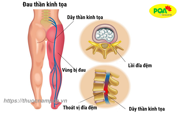 6 biến chứng đau thần kinh tọa gây ra nguy hiểm tới mức nào?