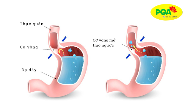 Mối liên quan giữa bệnh hen suyễn và trào ngược dạ dày thực quản