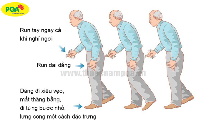 Bệnh Parkinson là gì? Nguyên nhân, dấu hiệu và chẩn đoán bệnh