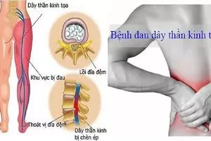 7 Cách chữa đau thần kinh tọa bằng Đông y cực kỳ hiệu quả