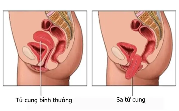 Bệnh sa tử cung sau sinh: Nguyên nhân và dấu hiệu nhận biết Bệnh sa tử cung sau sinh: Nguyên nhân và dấu hiệu nhận biết