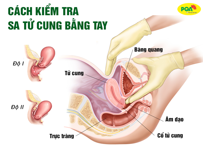 Hướng dẫn cách nhận biết sa tử cung bằng tay đơn giản tại nhà