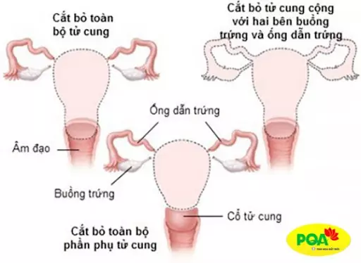 Những thay đổi sau khi cắt bỏ tử cung chị em nên biết sớm