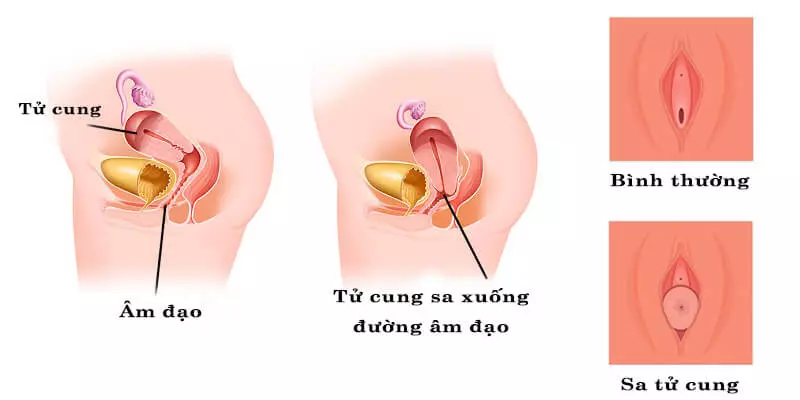 Hỏi - Đáp: Sau sinh ngồi nhiều có bị sa tử cung không?