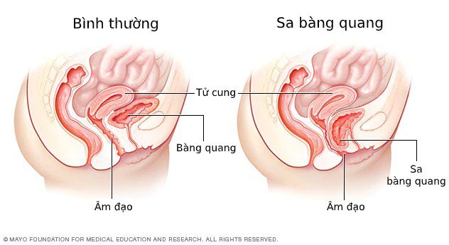 Sa tử cung có nguy hiểm không? 4 biến chứng không được chủ quan