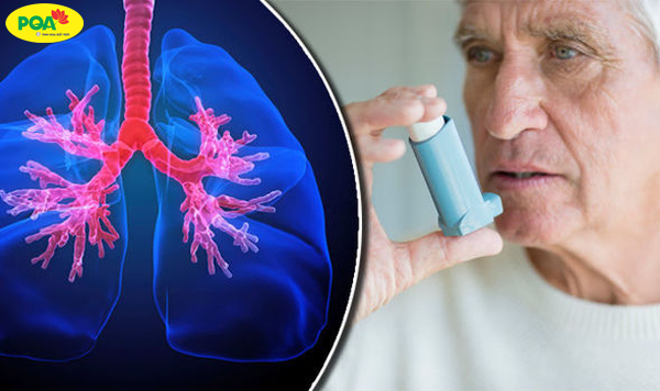 Bệnh hen suyễn sống được bao lâu? Cách kéo dài tuổi thọ