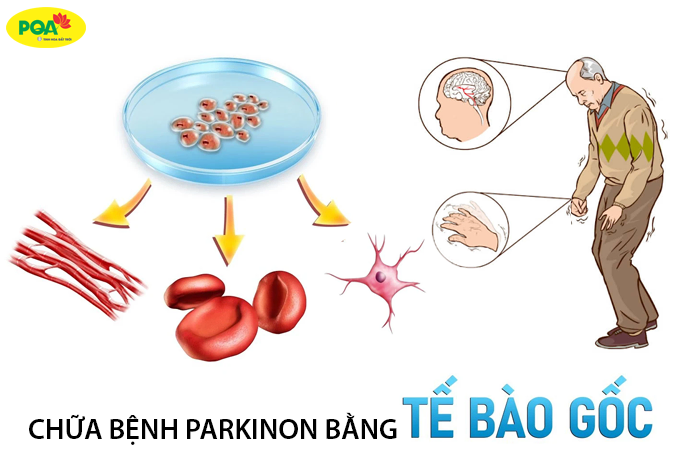 Chữa bệnh Parkinson bằng tế bào gốc như thế nào? Có hiệu quả không?