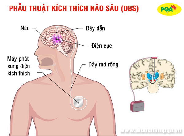 Chi phí phẫu thuật bệnh parkinson có đắt không? Lưu ý điều gì?
